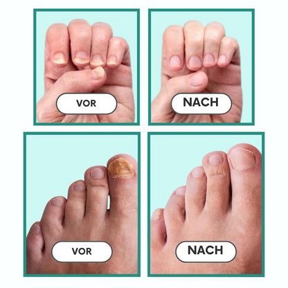 NailCure™ | Ultimative Nagelbehandlung für gesunde, schöne Nägel