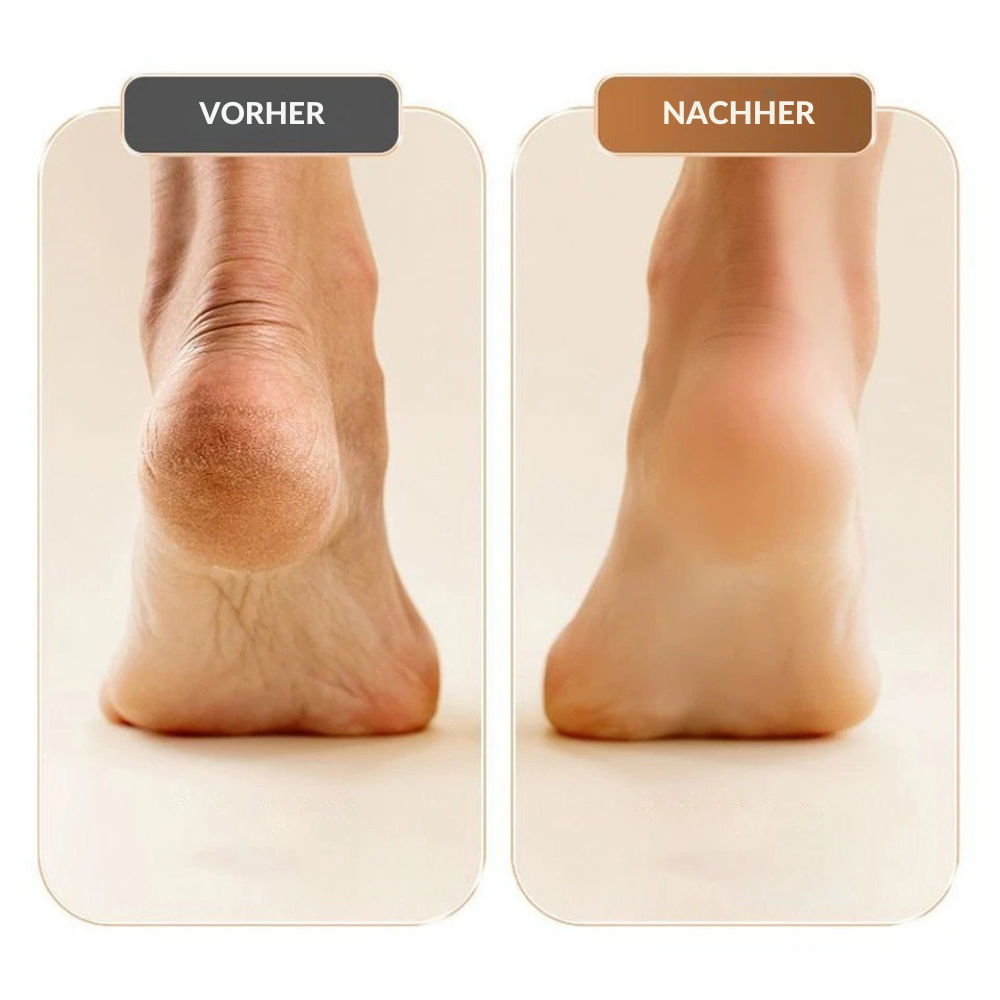 SilkSole™ | Elektrische Entfernung von verhornter Haut für glatte Füße