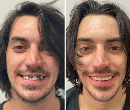 DentSecure™ Adhesive - Der thermoplastische Prothesenkleber, der Ihre Zähne 4 Tage lang hält, ohne zu versagen.