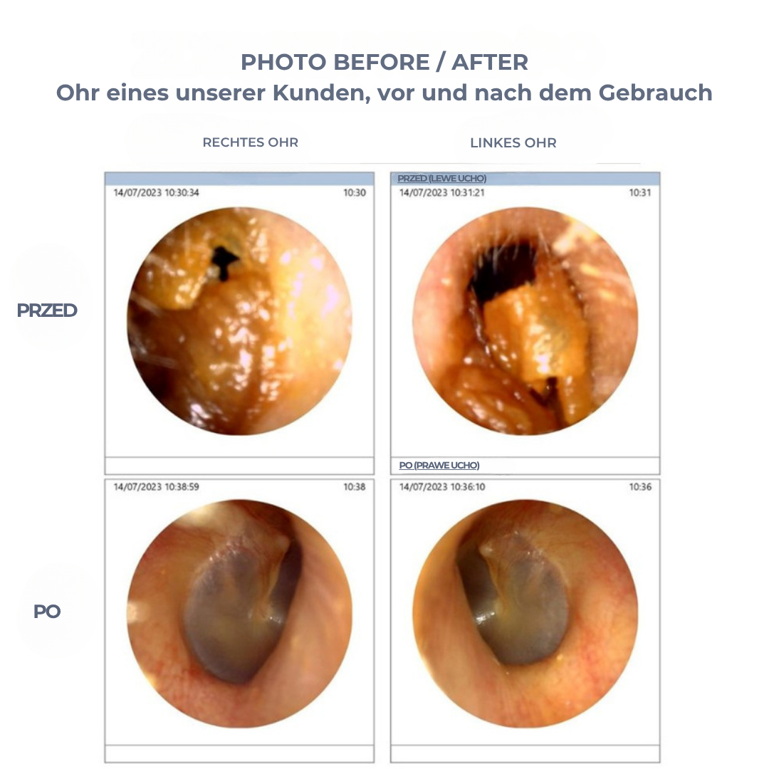 WaxClear™ | Intelligente Ohrenreinigung mit fortschrittlicher Technologie