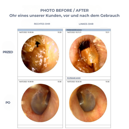 WaxClear™ | Intelligente Ohrenreinigung mit fortschrittlicher Technologie
