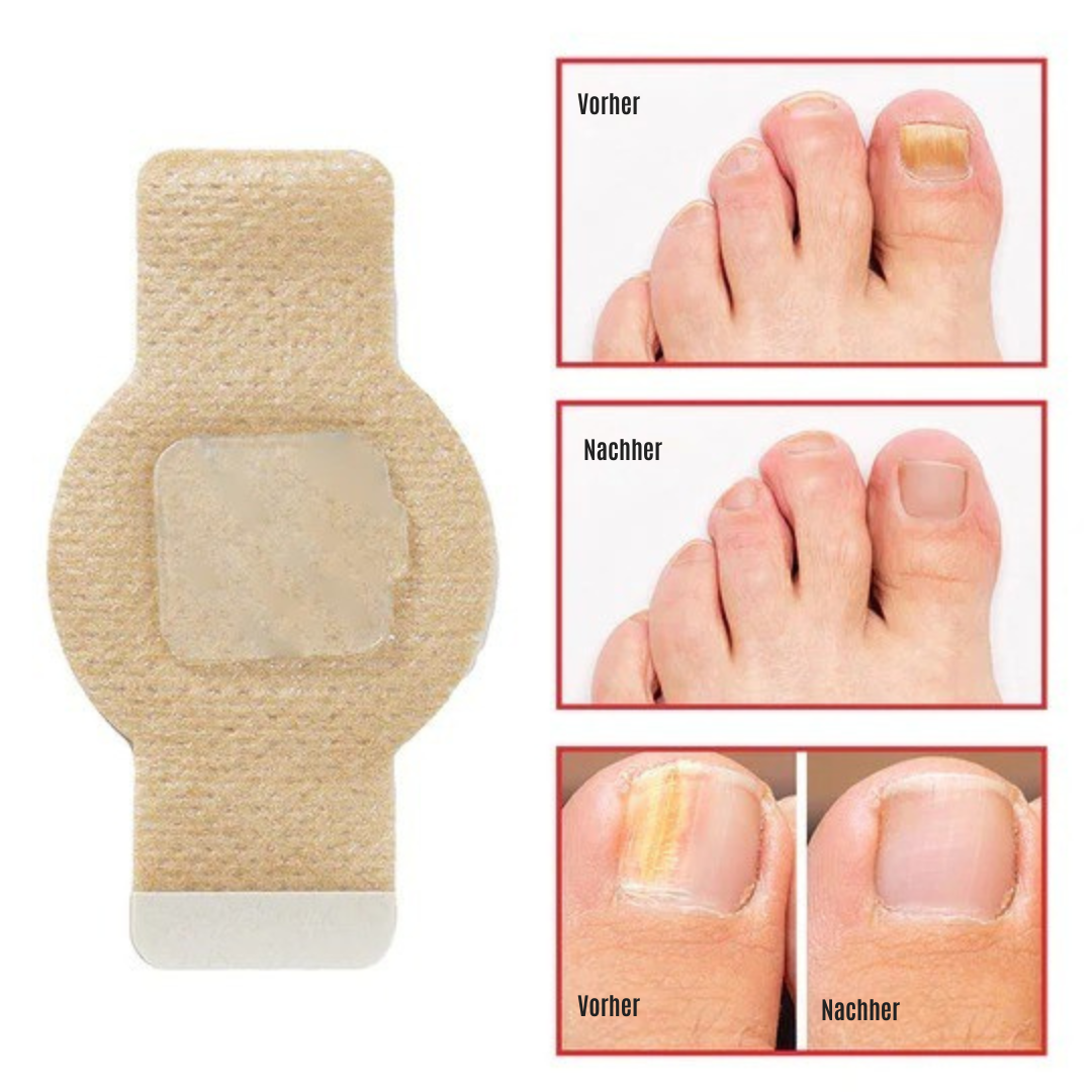 NailRepair™ | Pflaster gegen Nagelpilz