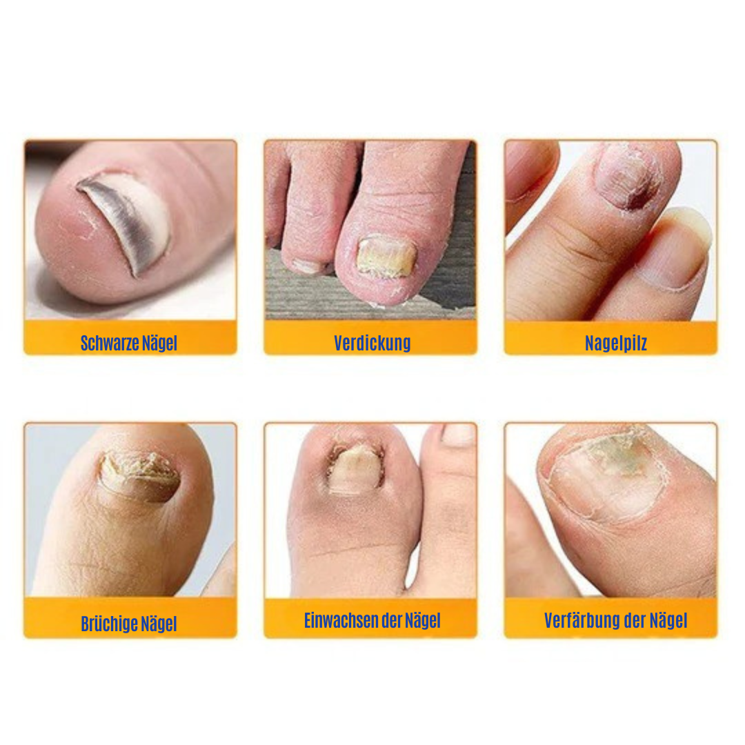 NailRepair™ | Pflaster gegen Nagelpilz