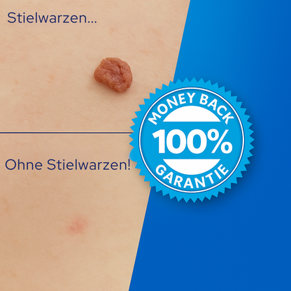 TagErase™ | Schluss mit Stielwarzen