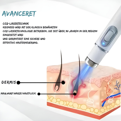 SilkLaser™ | Präzision und Sanftheit in einem