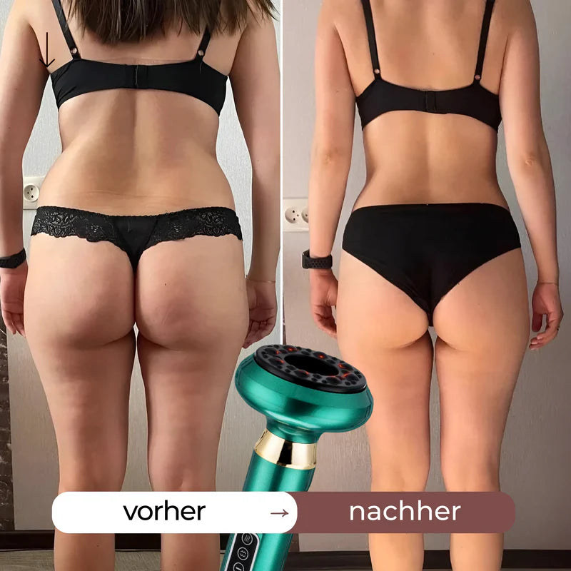 CelluSculpt™ | Erleben Sie eine sichtbar glattere und straffere Haut