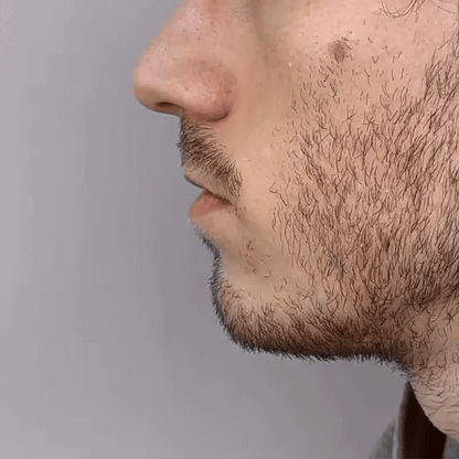 RhinoClear™ | Nasenbehandlung - Wieder Frei Atmen