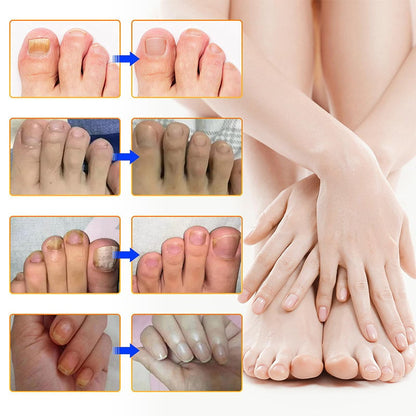 NailRepair™ | Pflaster gegen Nagelpilz